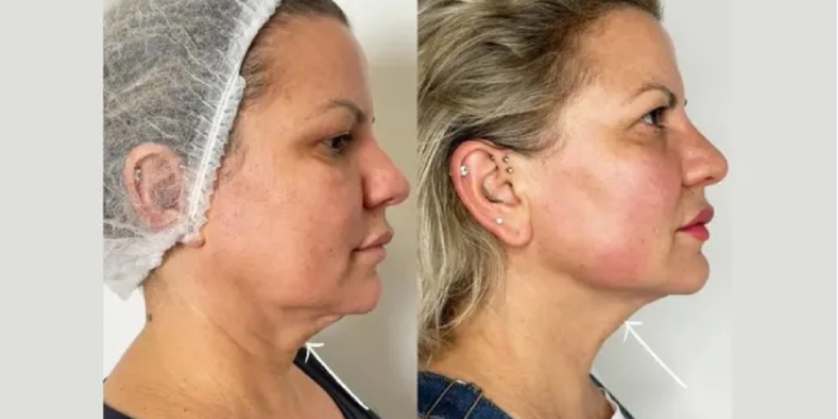 Endolift Treatment in Dubai: Collagen Stimulation Made Easy