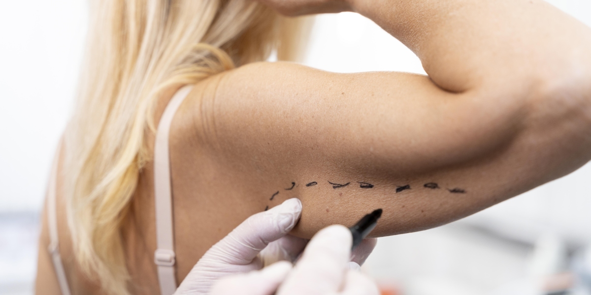 Arm Lift Surgery in Istanbul – Brachioplasty & Body Contouring