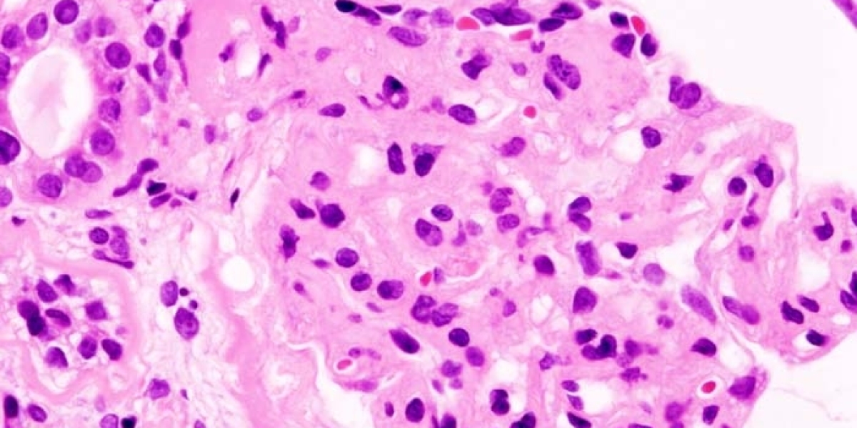 Exploring FSGS Causes and Nephrotic Syndrome Symptoms