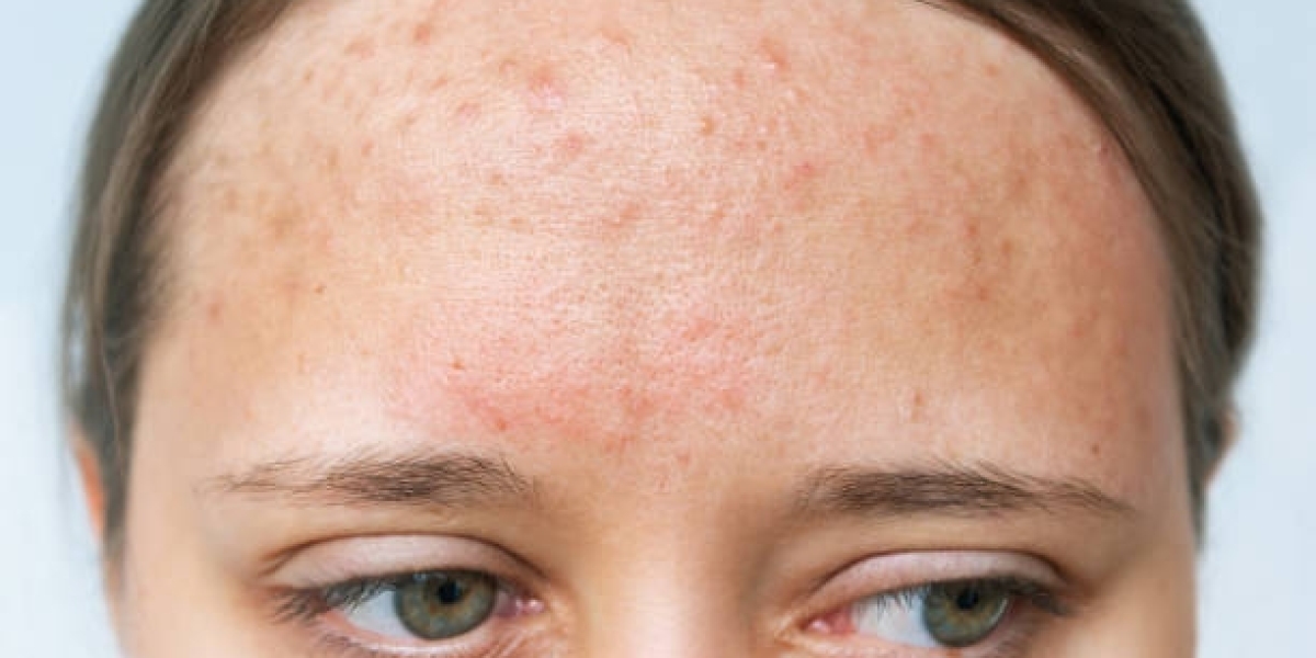 Discover Laser Acne Treatment for Brighter Complexion
