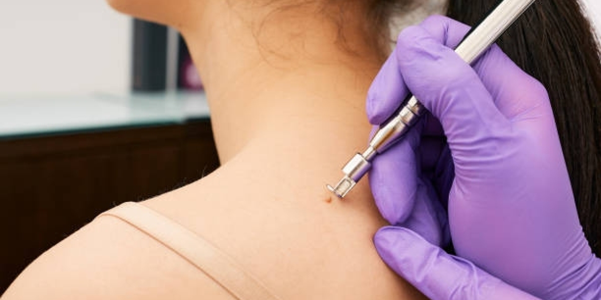 Transform Your Look: Expert Skin Tag Removal in Dubai