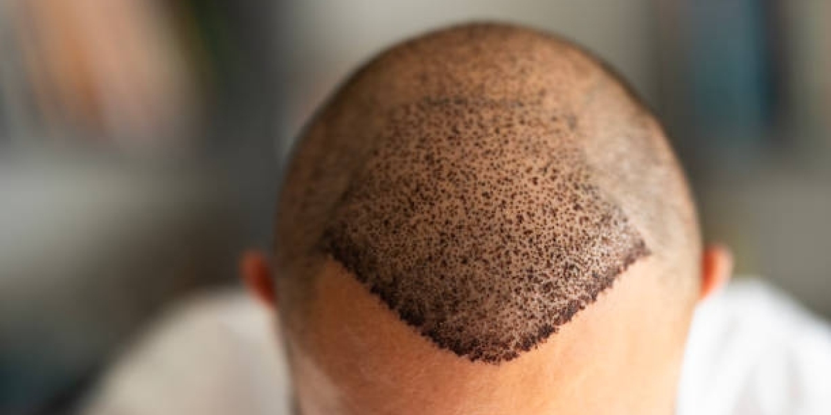 Hair Transplant Cost: Important Insights Before You Decide