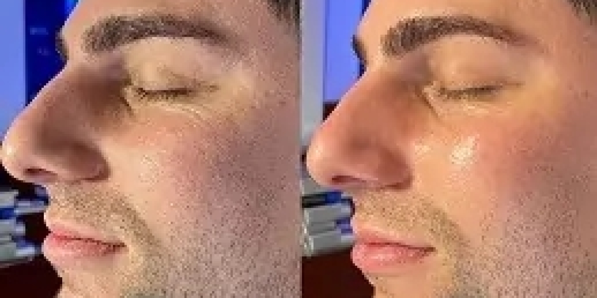 Is HydraFacial Expensive for Men in Dubai?