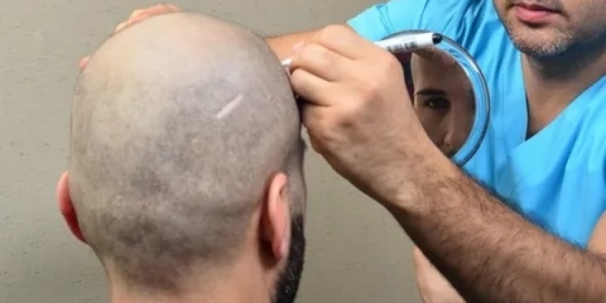 Hair Transplant in Riyadh: A Complete Guide for Natural Hair Restoration