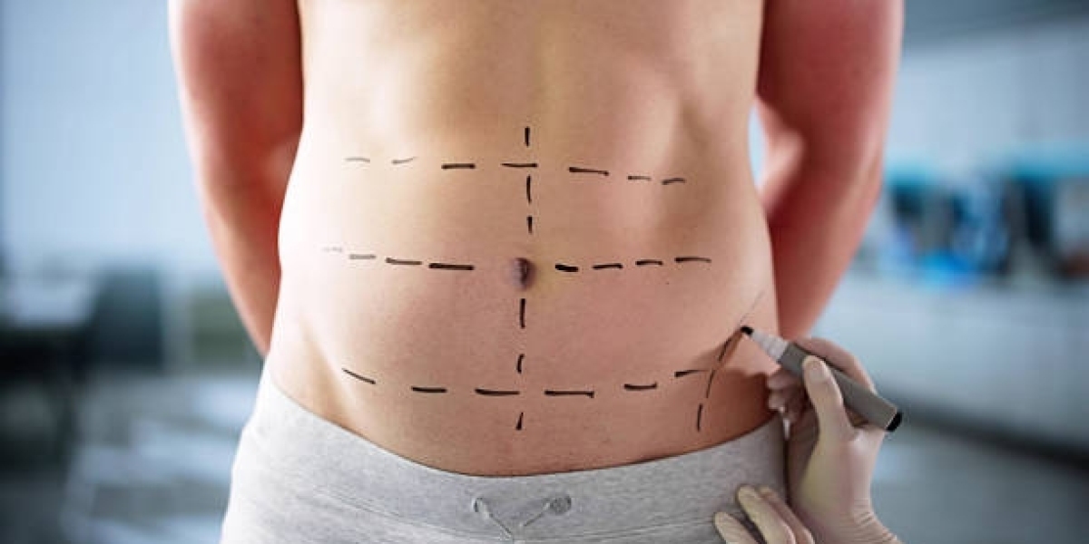 Tummy Tuck in Dubai: Skin Removal Mastery
