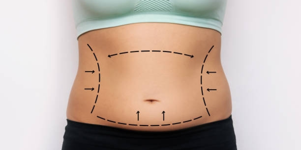 BodyTite Liposuction Prevents Loose Skin Issues