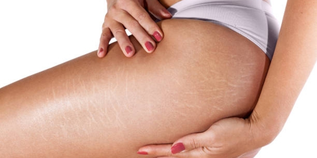 Stretch Mark Removal Techniques for Smoother Body Skin