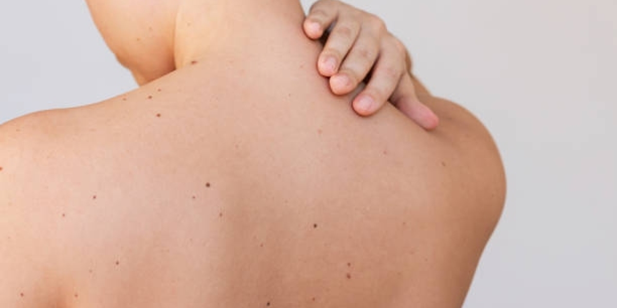 Skin Tag Removal Methods That Restore Natural Skin Texture