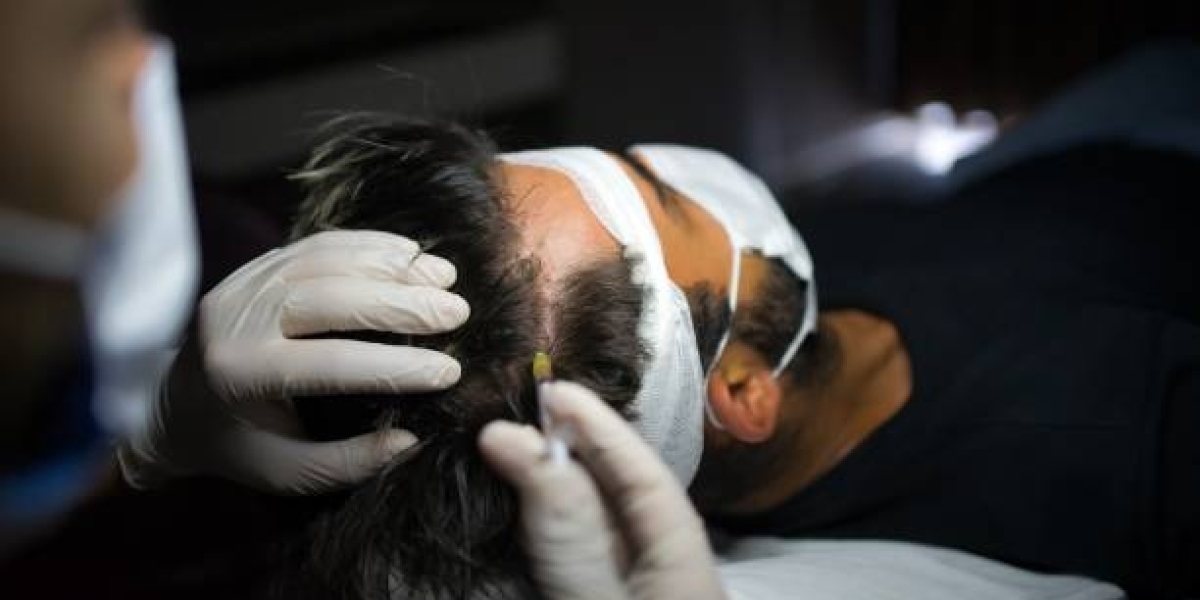 Plasma Injection for Hairs in Dubai: A Natural Way to Enhance Hair Quality