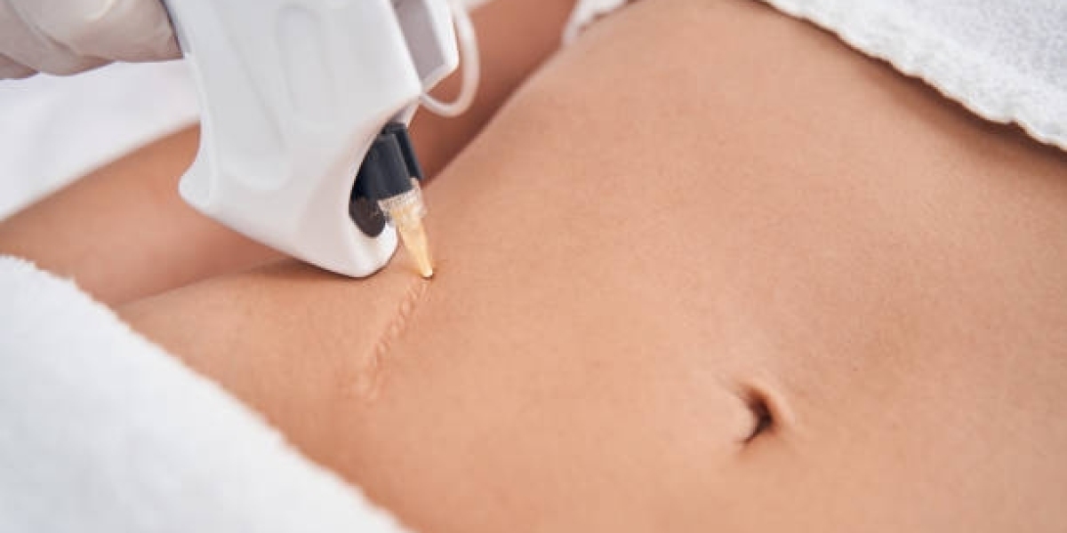 Laser Scar Removal Using Advanced Dermatology Lasers