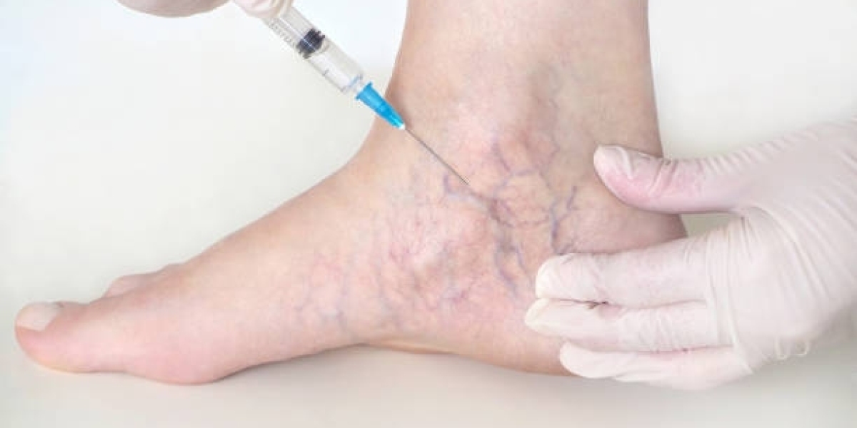 Varicose Vein Treatment Relieves Heavy Leg Feeling