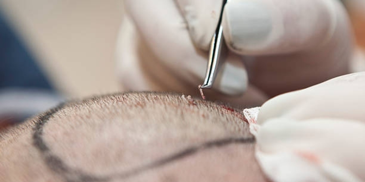 Factors That Influence Hair Transplant Pricing in Dubai