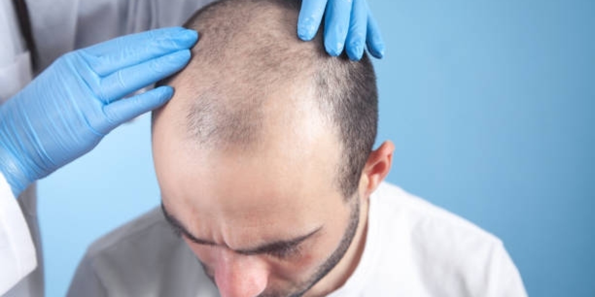Hair Transplant in Dubai: Addressing Hair Loss with Confidence