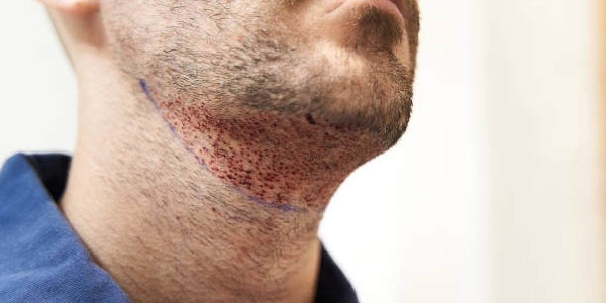 Beard Hair Transplant in Dubai: Techniques, Safety, and Results