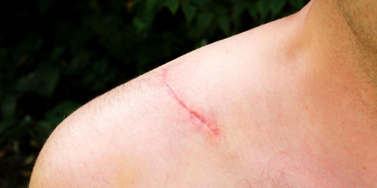 Stretch Mark Removal That Helps You Feel Comfortable in Your Skin