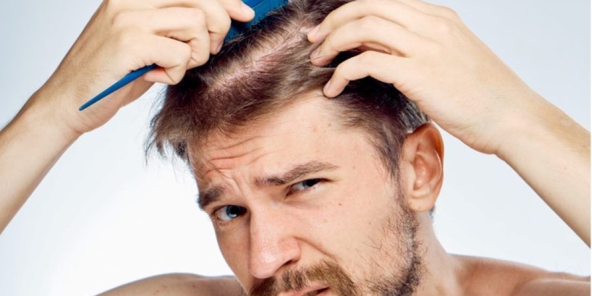 How Density Achieved In Hair Transplant?