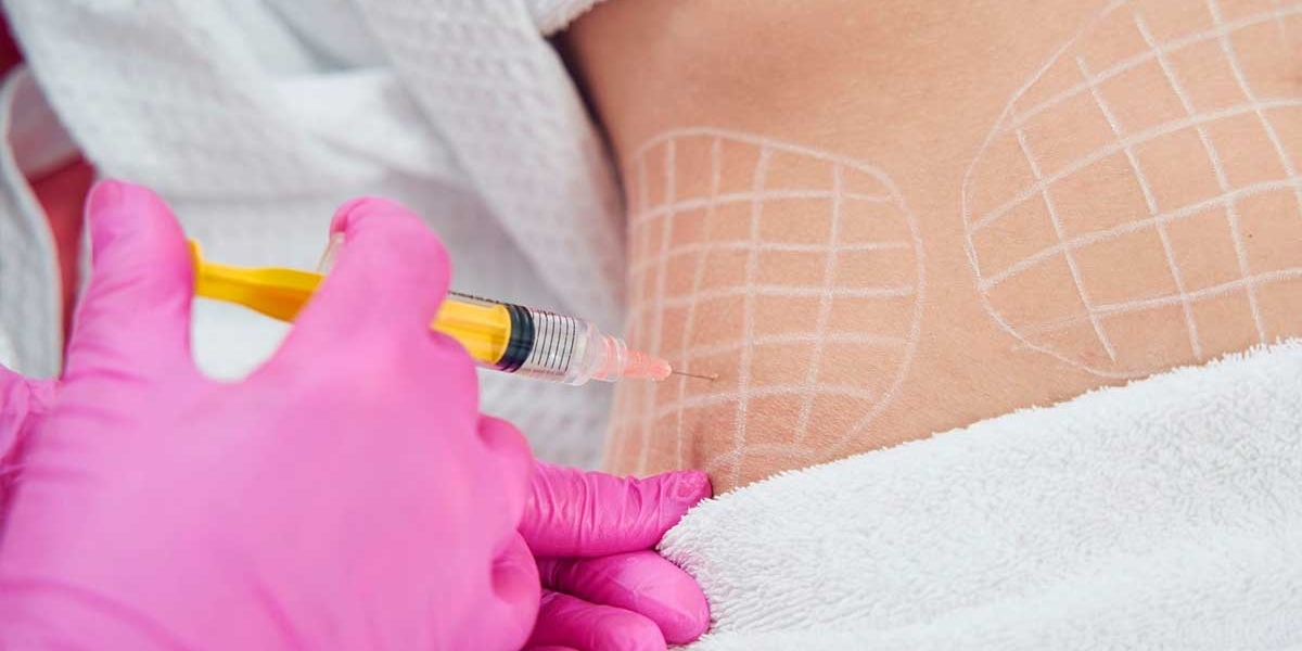 BodyTite Liposuction for a Sleeker Silhouette: What You Need to Know?