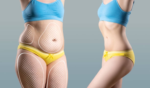 liposuction in Riyadh saudia Profile Picture