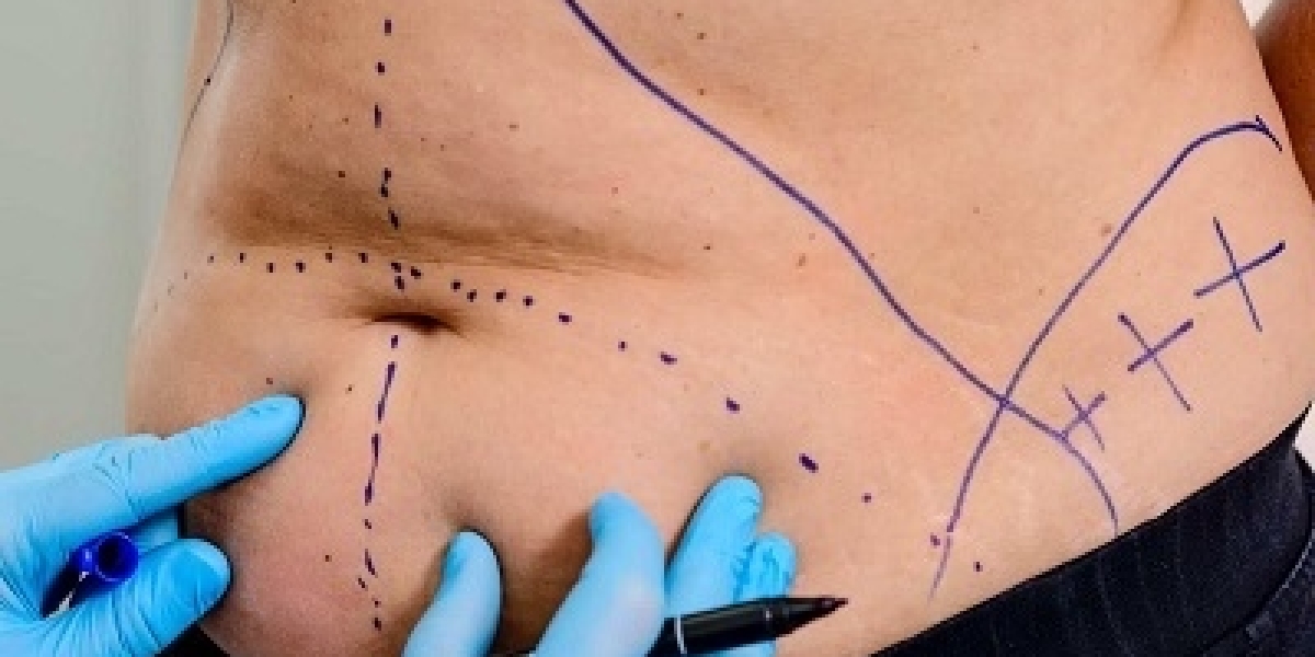 How to Maximize Value While Choosing Liposuction in Riyadh