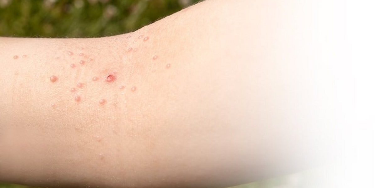 Warts Removal in Dubai: What Doctors Recommend