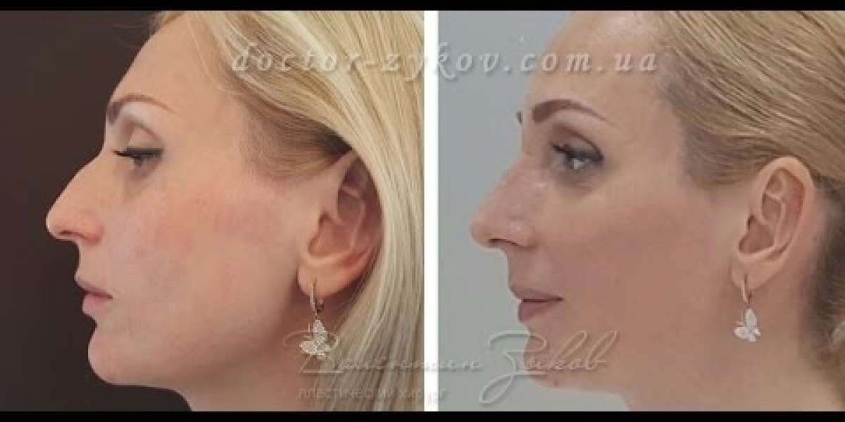 Frequently Asked Questions About Riyadh Rhinoplasty