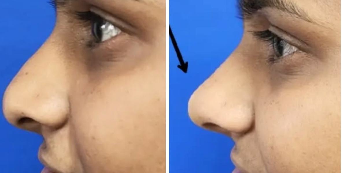 Non-Surgical Facelift in Pune: Real HIFU Results at Zayn Skin Clinic (Before & After)