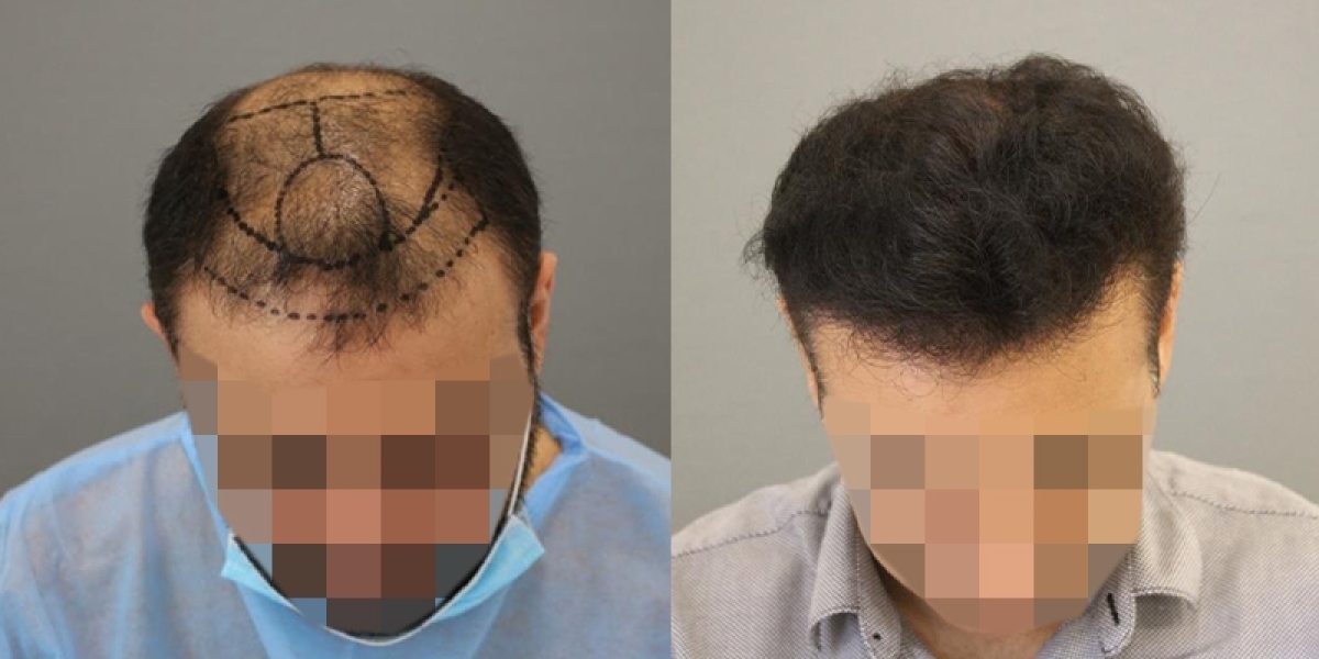 The Science of Growth: Modern Hair Transplant in Riyadh