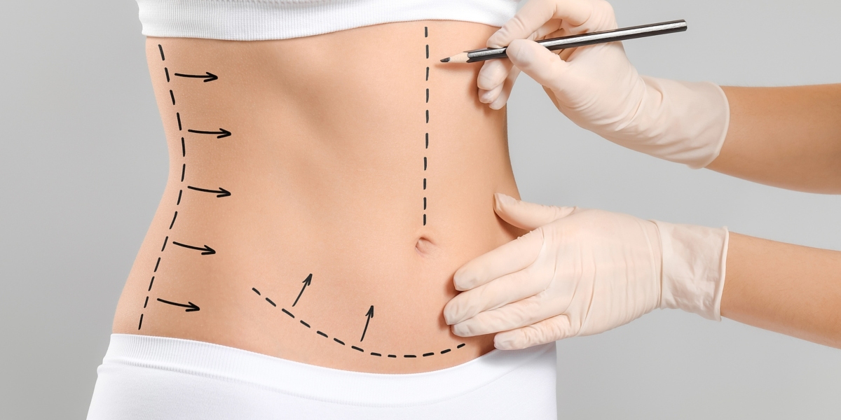 the financial landscape for liposuction surgery in Riyadh