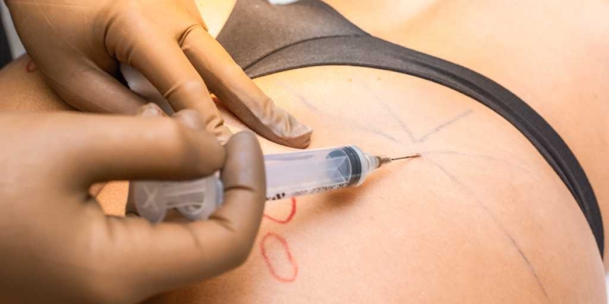 How Many Sessions of Butt & Body Fillers Do You Need?