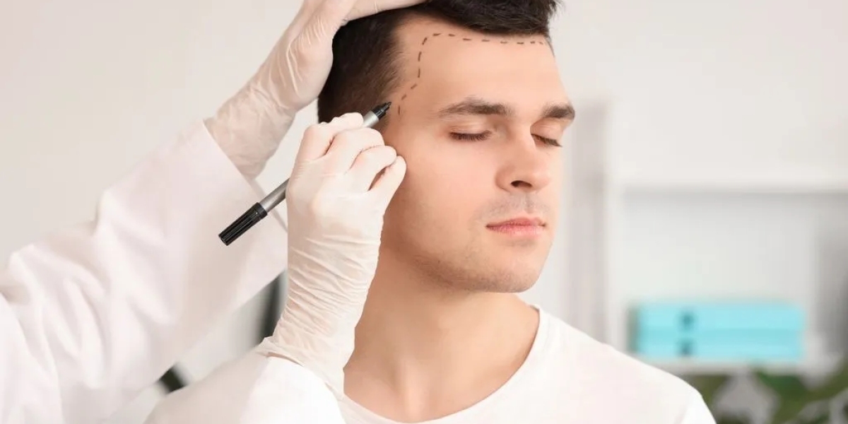 Can Scarless Hair Transplant Be Repeated