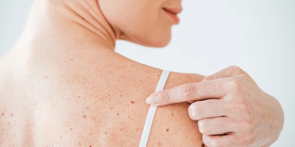 Skin Lesion Removal in Islamabad: Is It Painful?