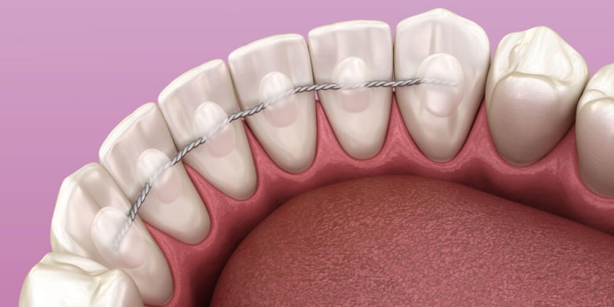 How Lingual Dental Braces Work Behind Your Teeth