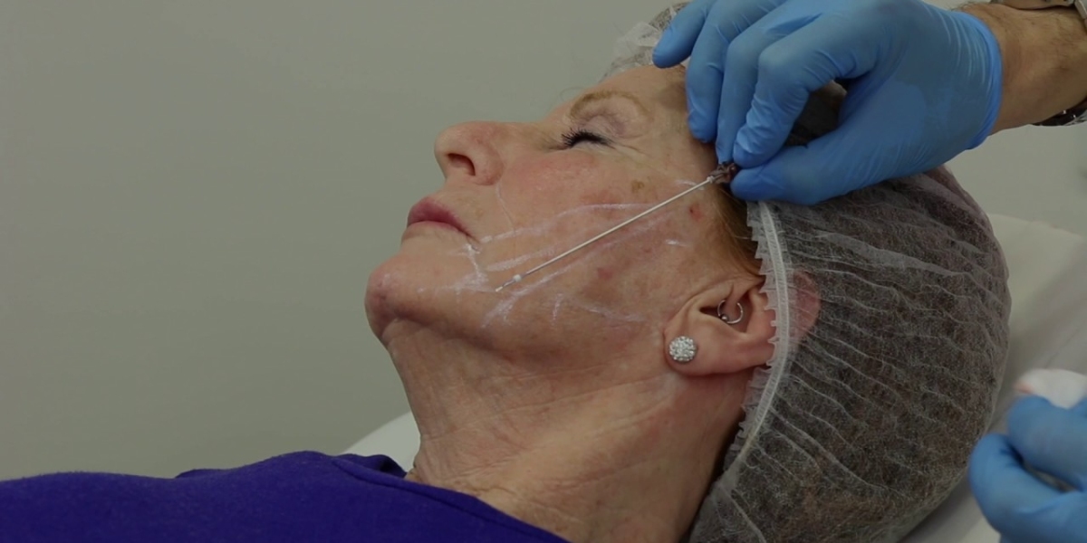 How Silhouette Soft Thread Lift Works: Islamabad Treatment Guide