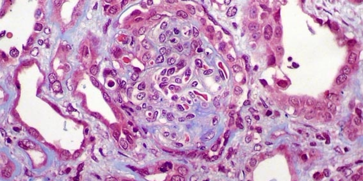 Understanding FSGS Signs, Symptoms and Treatment Options Clearly