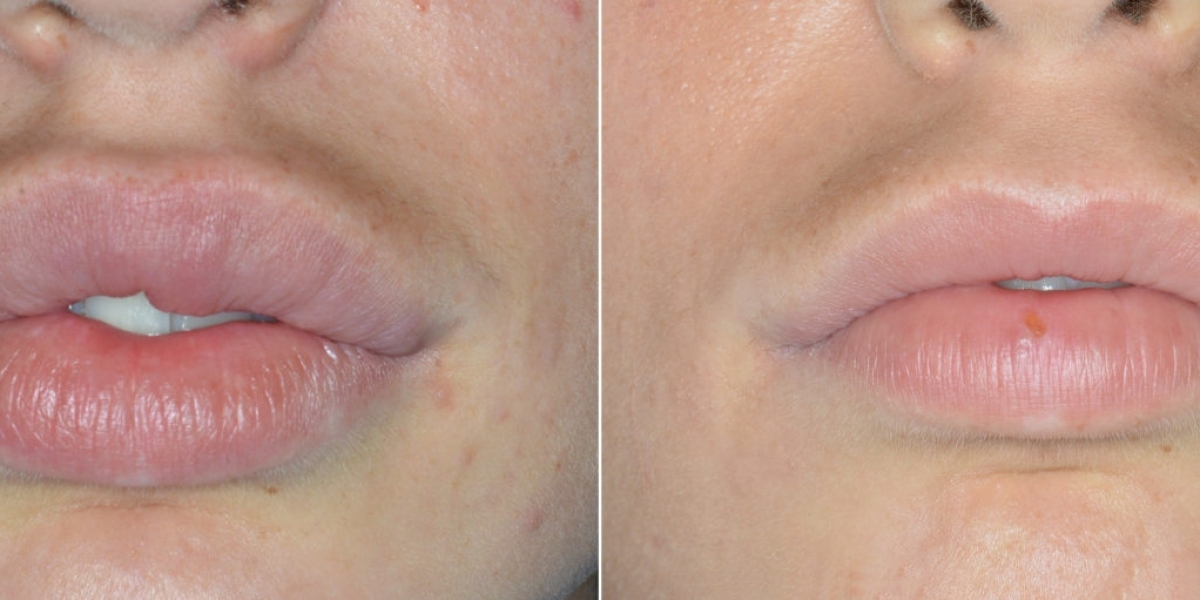 A Closer Look at Lip Reduction Surgery in Riyadh