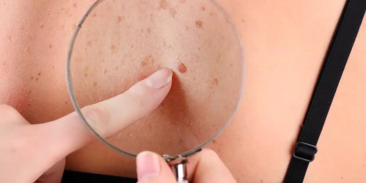 Skin Tag Removal Treatments Dermatologist-Recommended Options