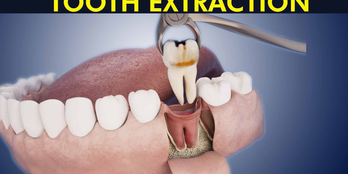 Tooth Extraction in Springtown: When Is It Necessary?
