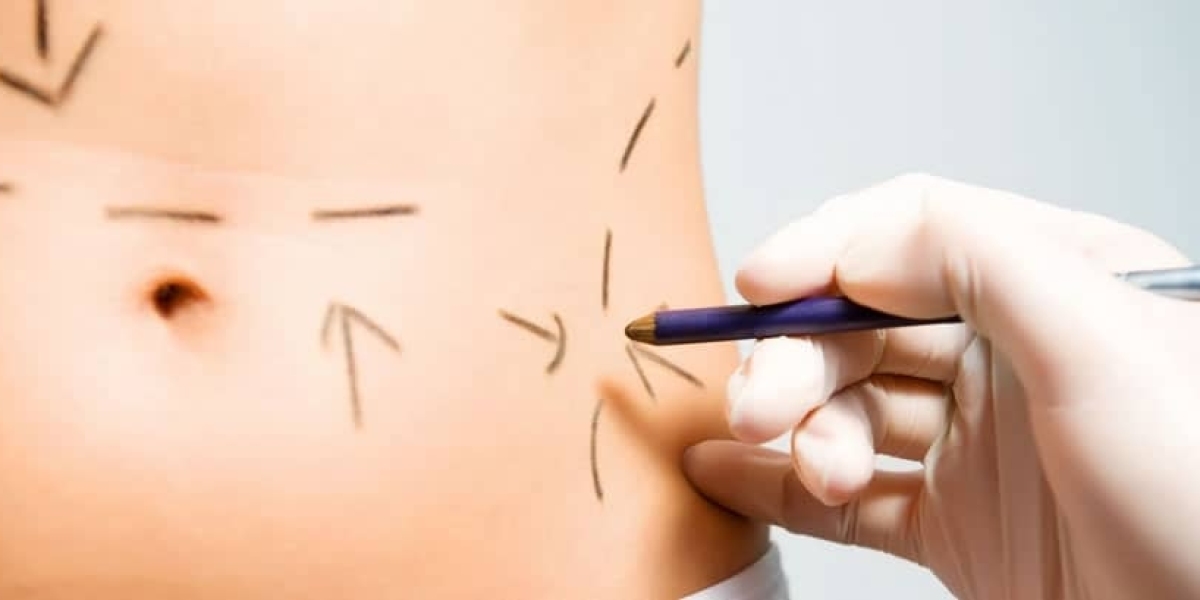 Addressing Common Questions About Body Lift Surgery in Riyadh