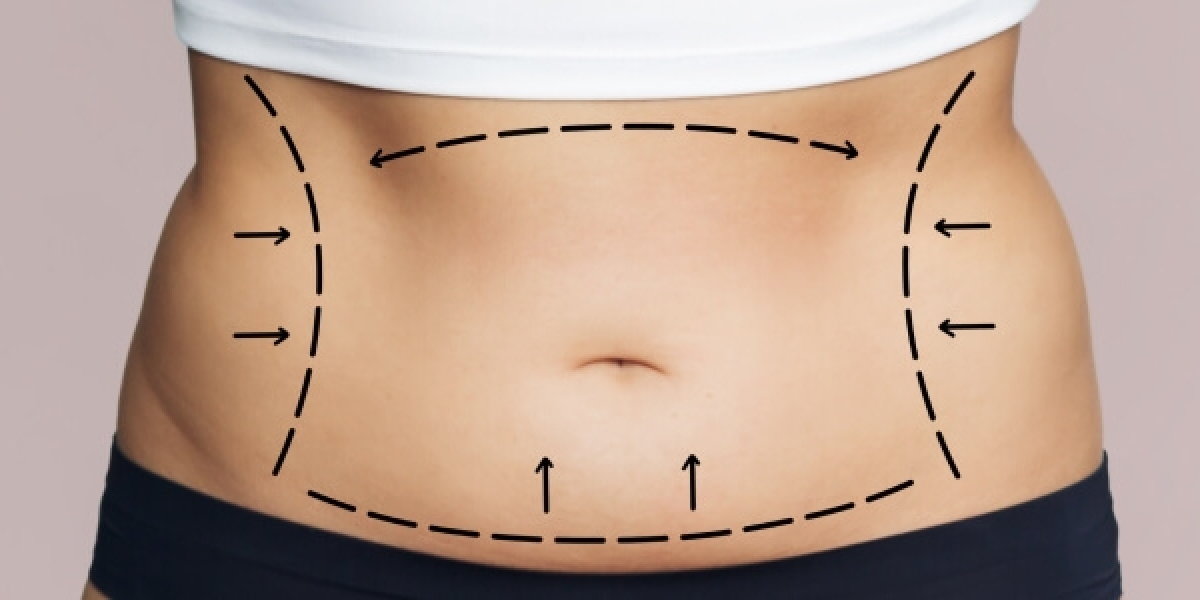 Benefits and Results of Mini Abdominoplasty in Riyadh for Post-Pregnancy Recovery