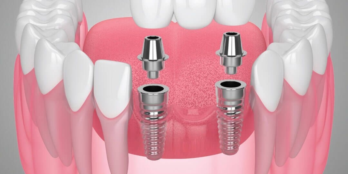 Why Do Experts Support Dental Crowns and Bridges in Dubai?