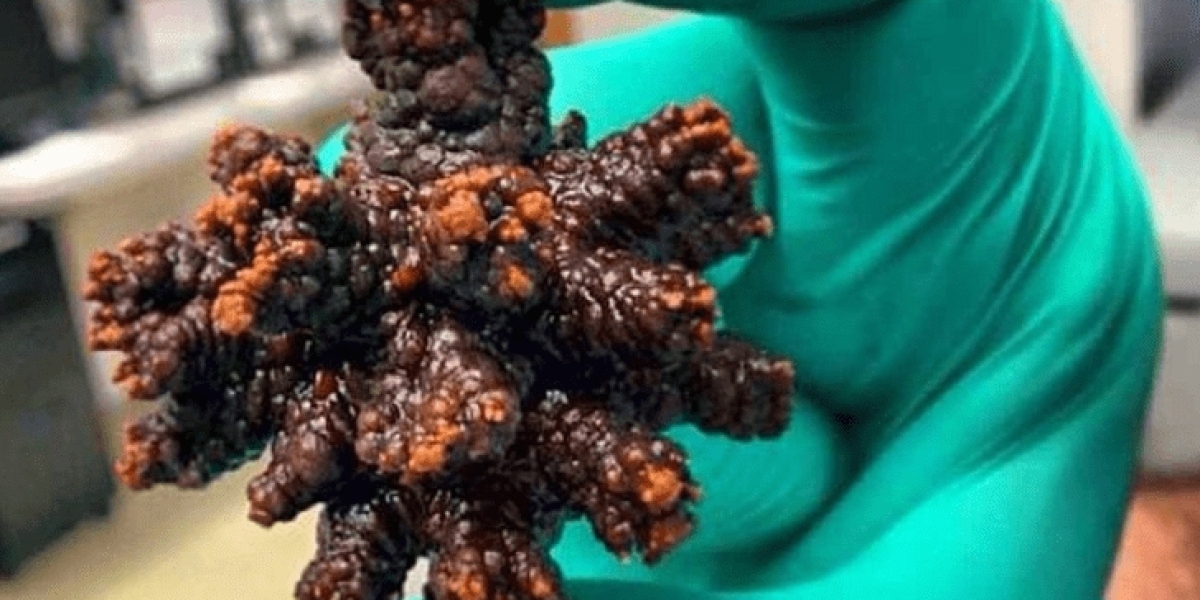 Bladder Stones: Causes, Symptoms, Diagnosis, and Effective Treatment Options